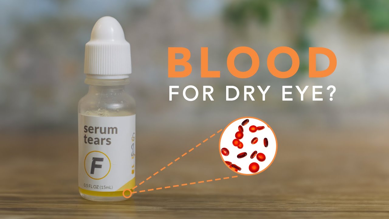 Healing with Your Own Blood: Autologous Serum Eye Drops in Dry Eye Disease