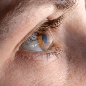 A-close-up-of-an-eye-showing-a-cone-shape-cornea. 
