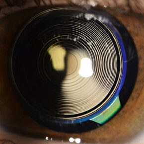 Multifocal-lens-implant 